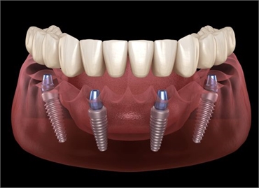 All on four dental implants turkey