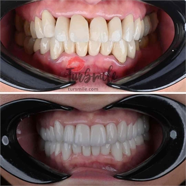 Before  After zirconium crown turkey