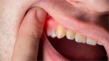 Comprehensive Guide to Periodontal Treatment Protecting Your Gum Health