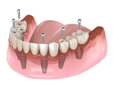 Willow Grove Dental Implants Center