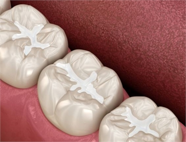 Dental Sealants on Molars