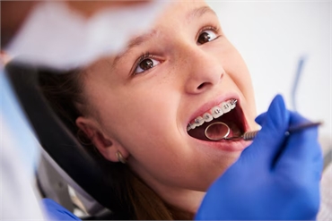 Braces for Children Everything Parents Need to Know FAQ's