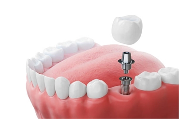 Dental Implants Burlington for Different Types of Tooth Loss