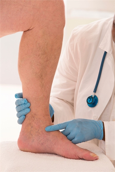 Does Genetics Play a Role in Varicose Vein Treatment Success