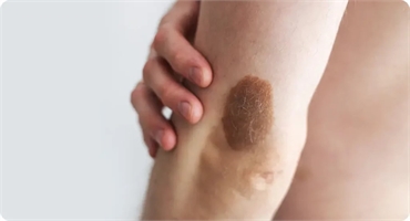 Can Brown Birthmarks Be Removed Completely