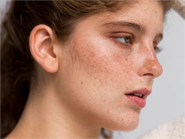 Can Chemical Peels Remove Melasma