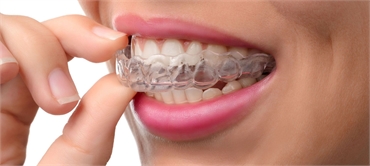 The Top Invisalign Treatment Options for Straight  Healthy Teeth