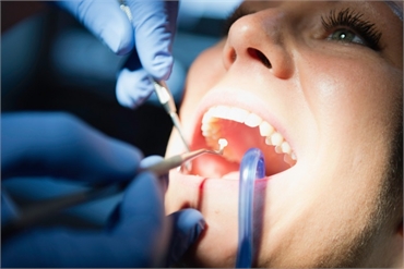 What to Expect with a Tooth Filling