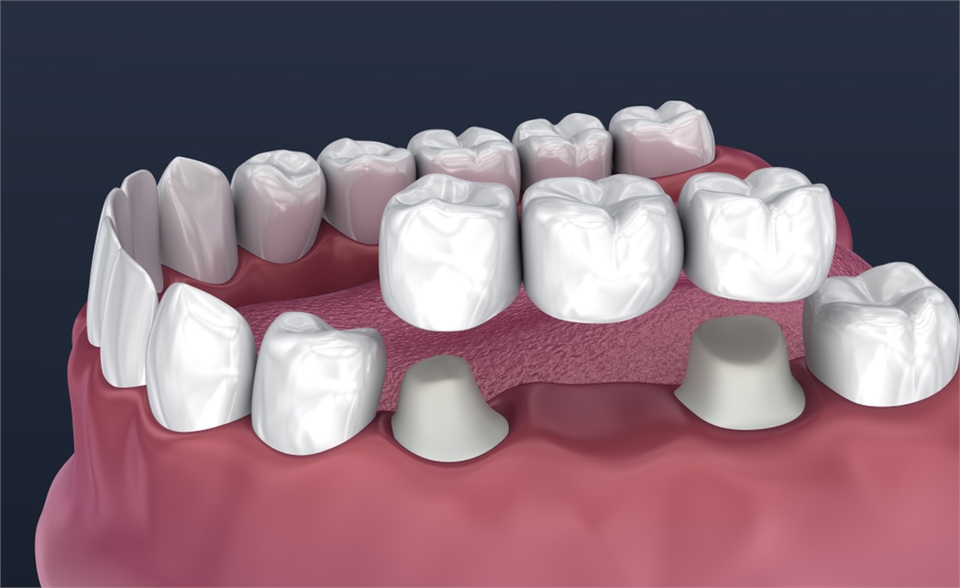 Dental Bridges