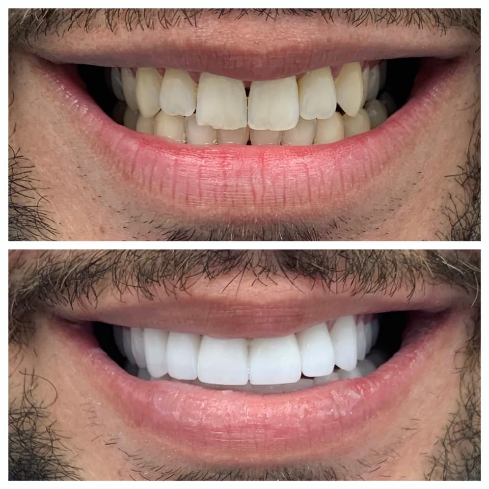 Dental Veneers