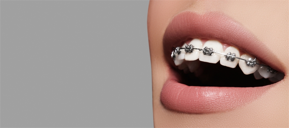 Dental Braces