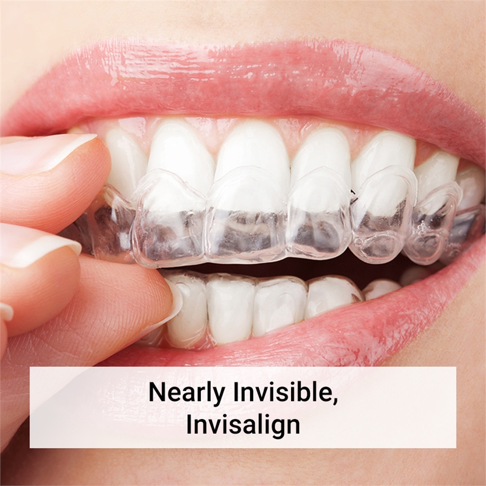 Invisalign Treatment Clear Braces Aligners Las Vegas