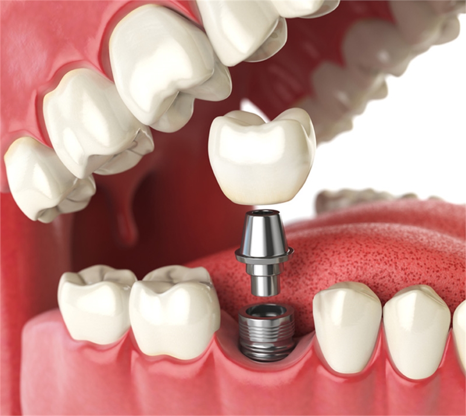 Dental Implants