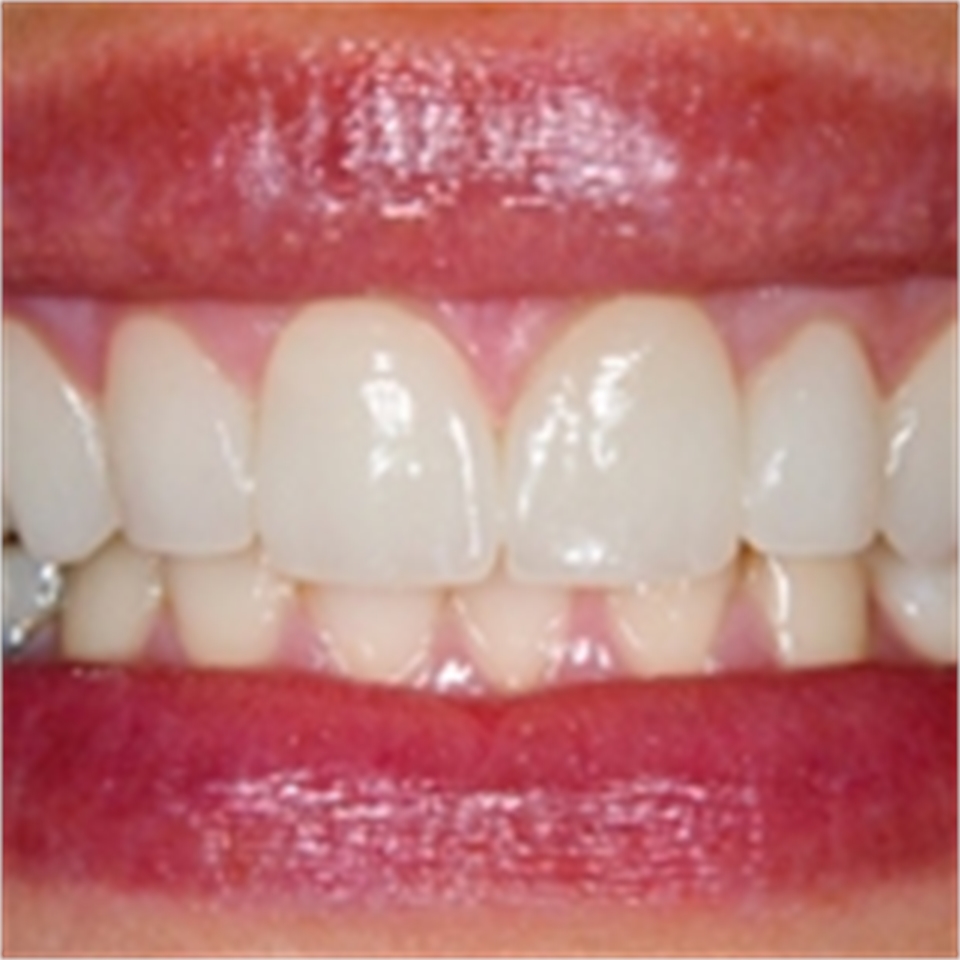 Veneers Dentagama