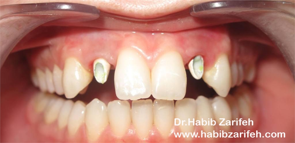 during prothesis step of dental implants