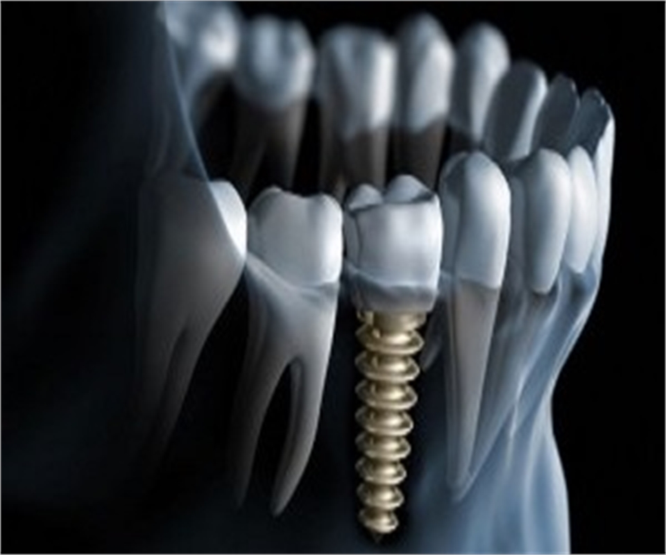 Dental Implants in Delhi Dentagama