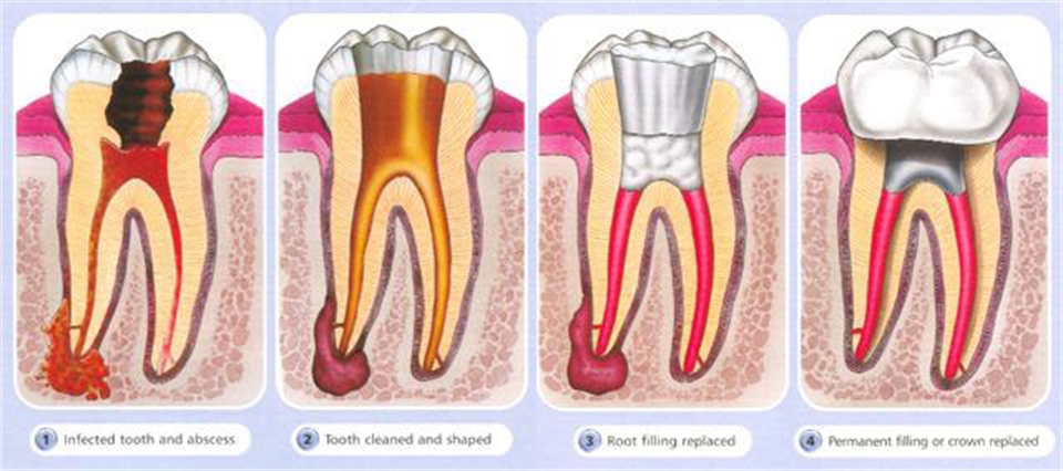 Root Canal Therapy