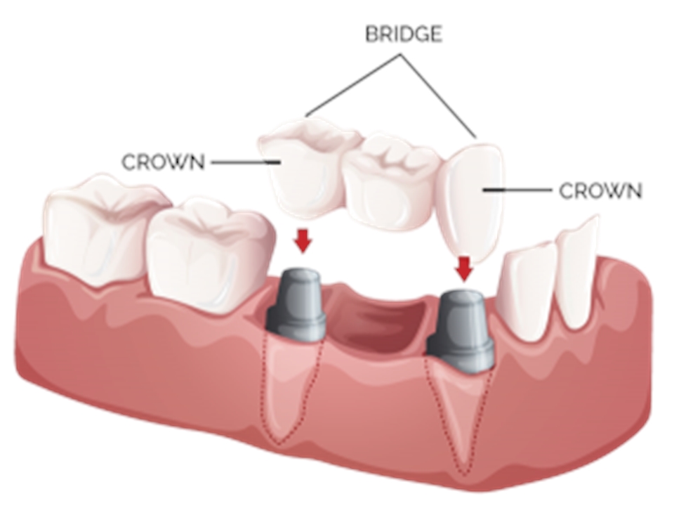 Crowns And Bridges