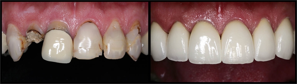 Crowns Before And After 