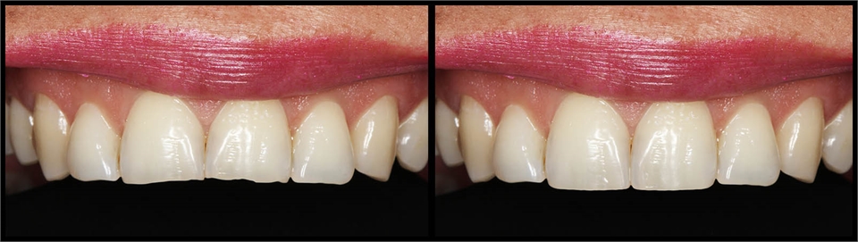 Filling On Edge Before And After 