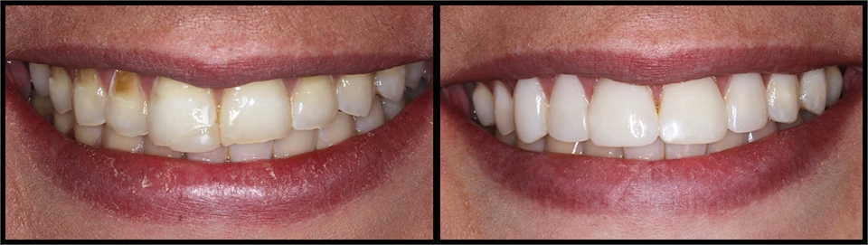 Bonding Before And After 