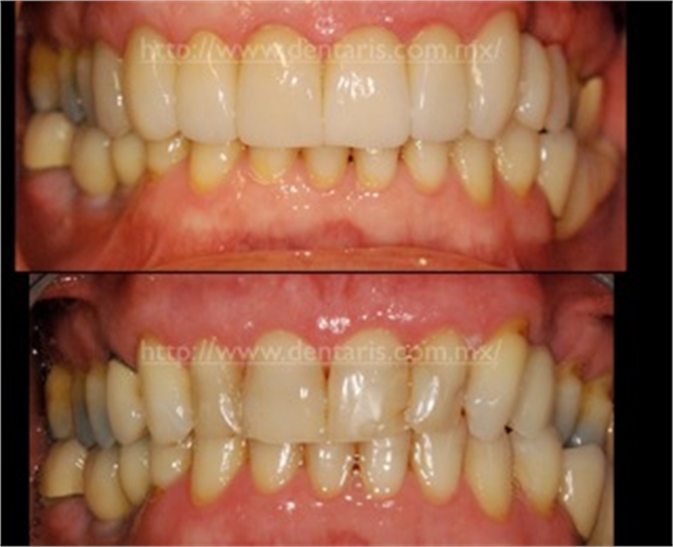 Porcelain Veneers Cancun Dentaris Dentagama
