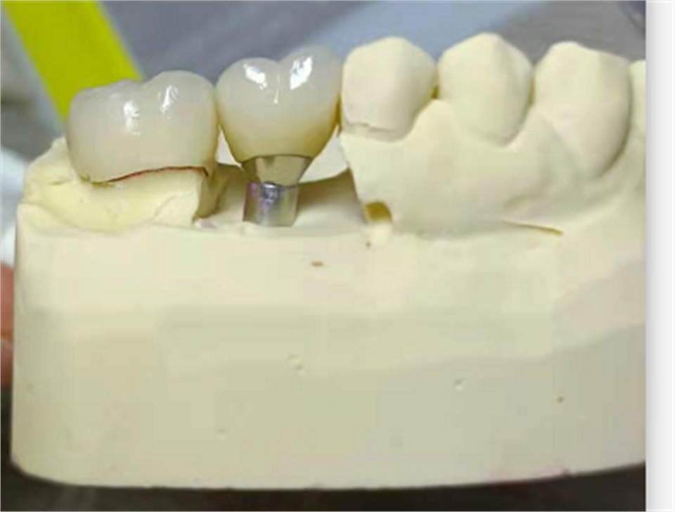 PFM Implant 