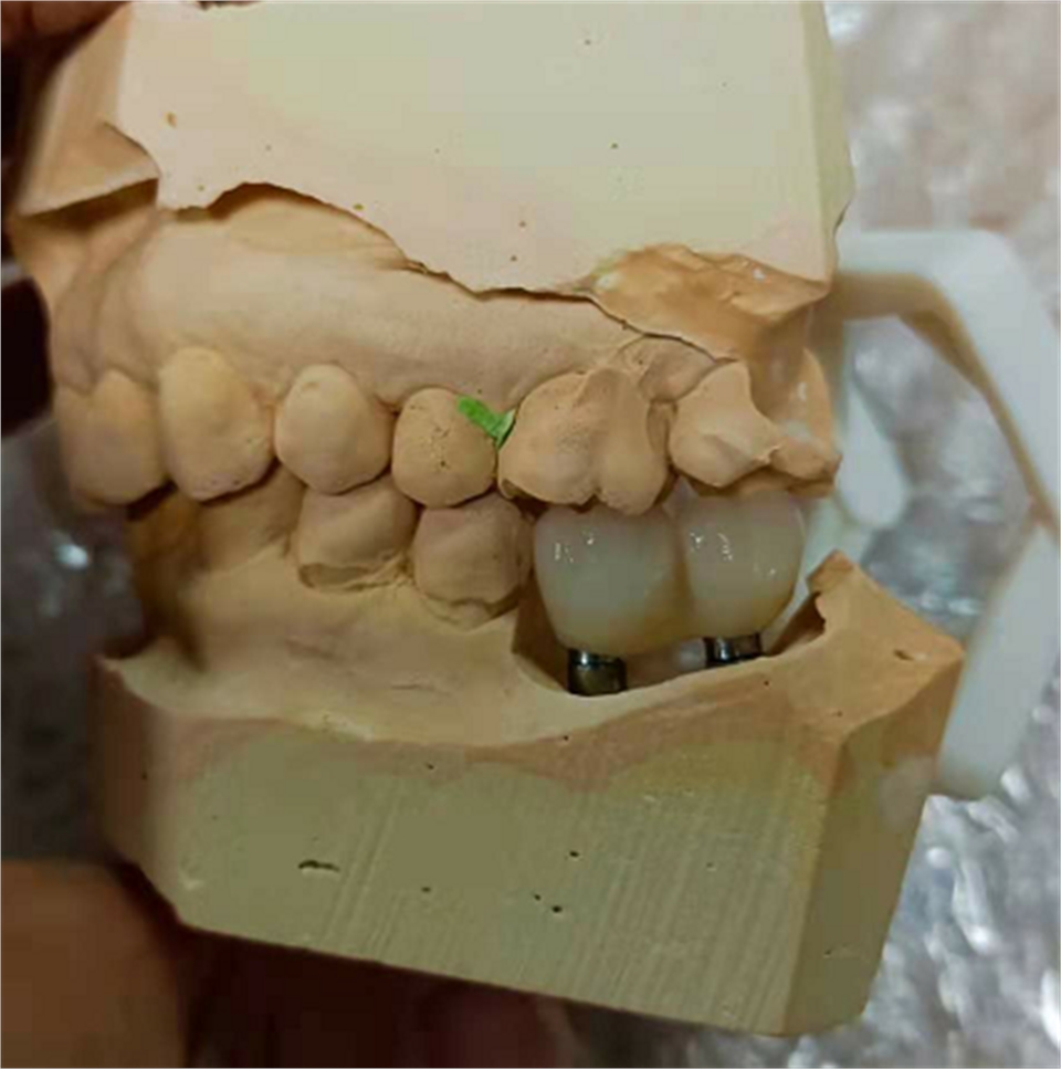 Zirconium implant 