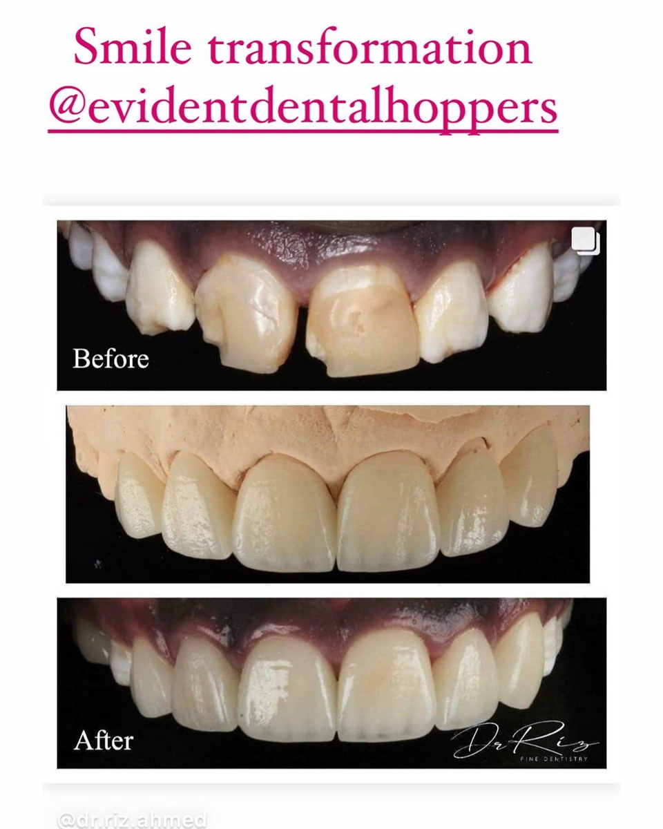 HCFD Smile transformation