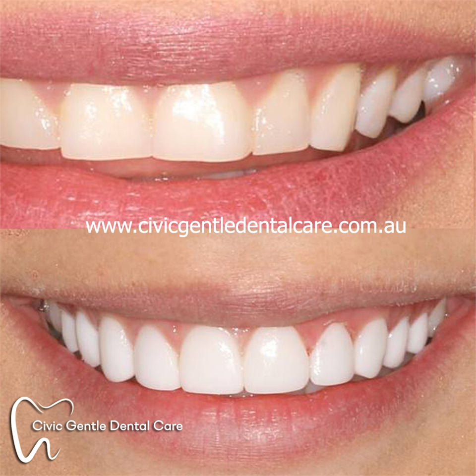 Veneer Teeth