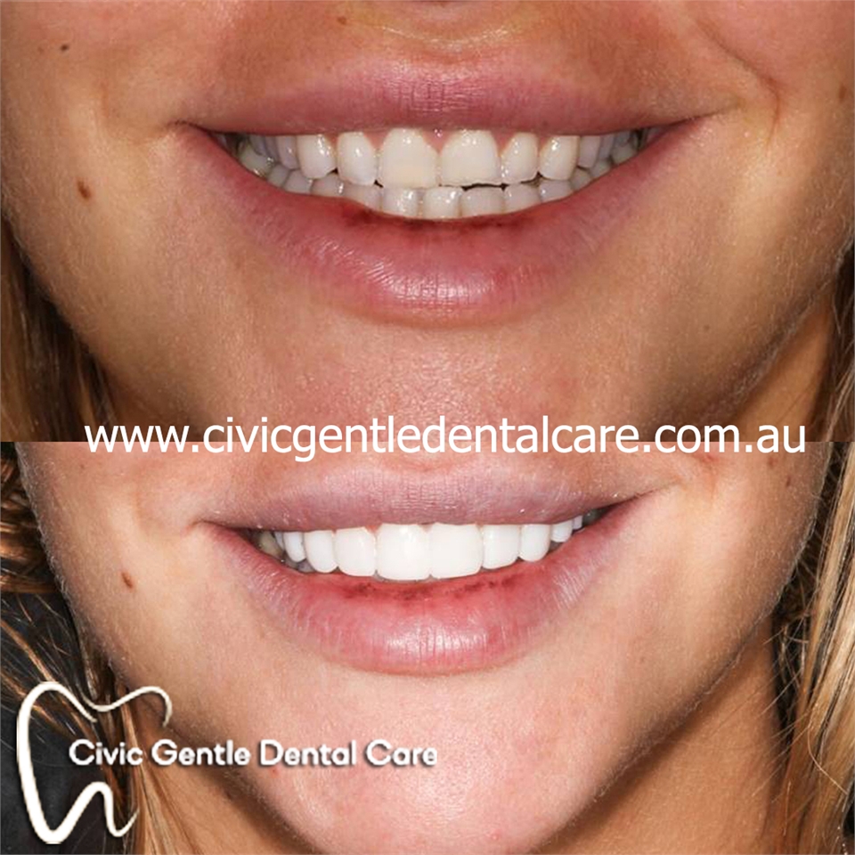 Canberra Dental Crowns