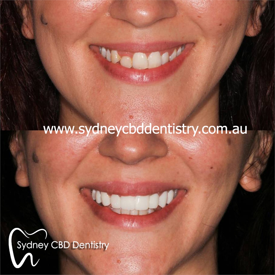 Veneers Sydney