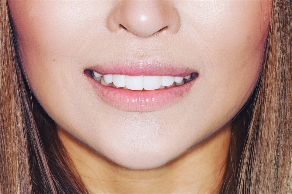 Dental Veneers Dentagama