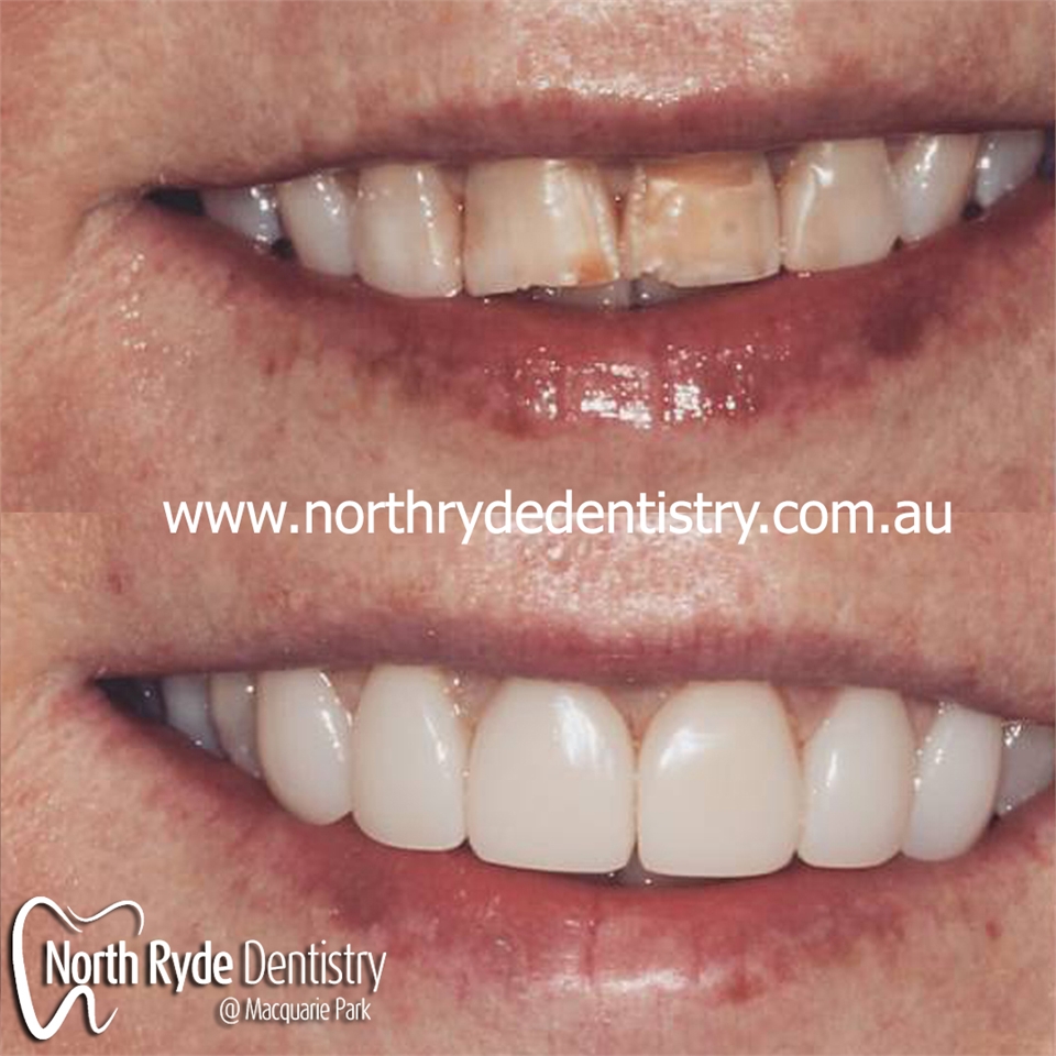 North Ryde Composite veneer