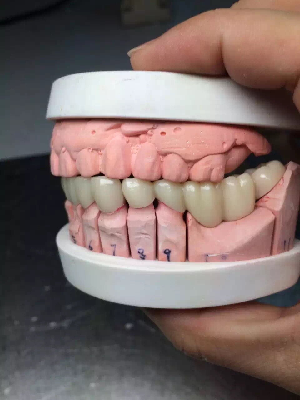 all ceramic restorations