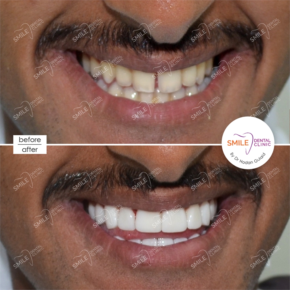 Veneers in Dubai Dentagama