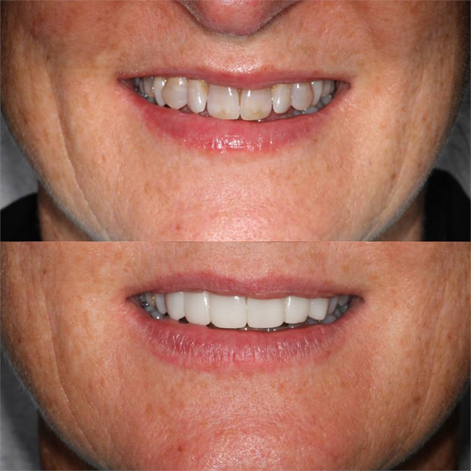 North Sydney Dental Veneers