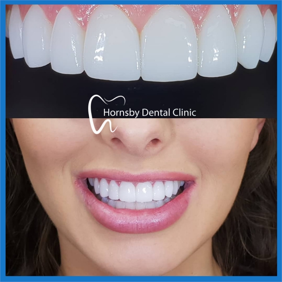 Dental Veneers
