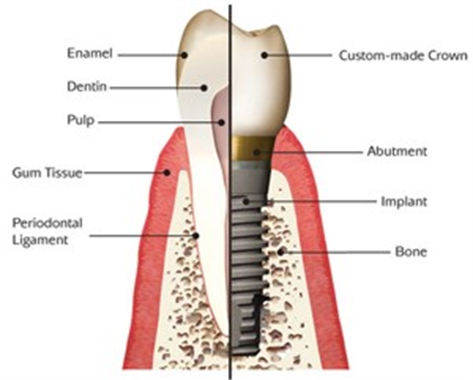 DENTAL IMPLANTS