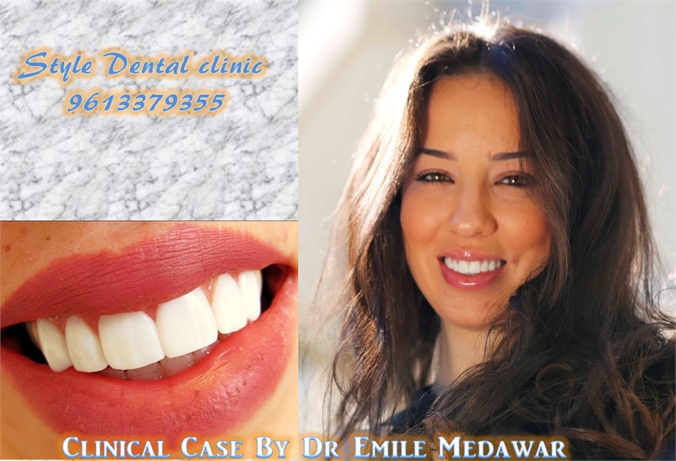 veneers lebanon beirut