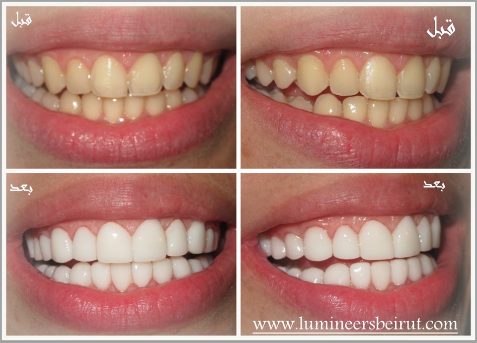 Hollywood smile Lebanon