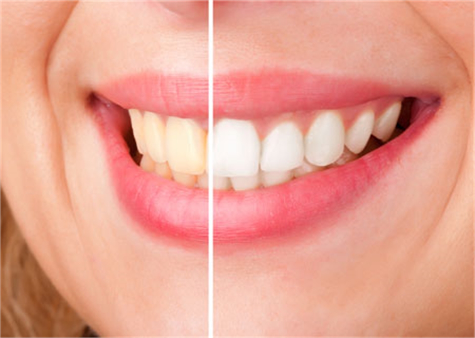 Zoom Teeth Whitening