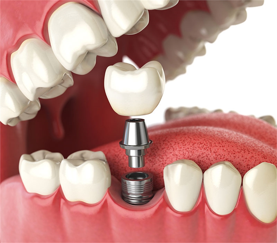 Dental Implants in New Port Richey