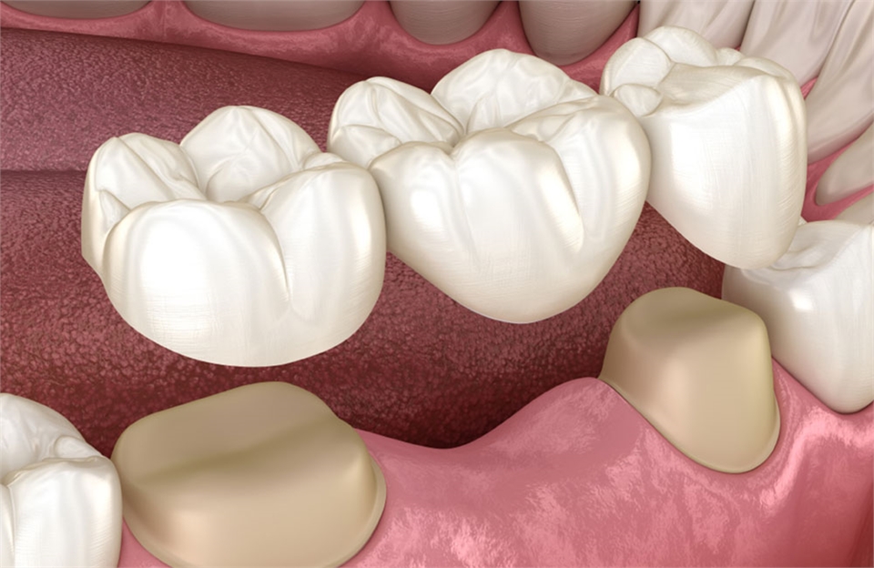 Dental Bridges in New Port Richey