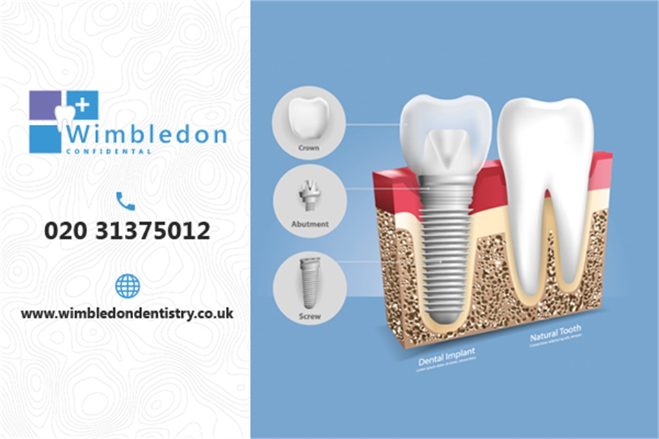 Dental Implants Treatment Dentagama