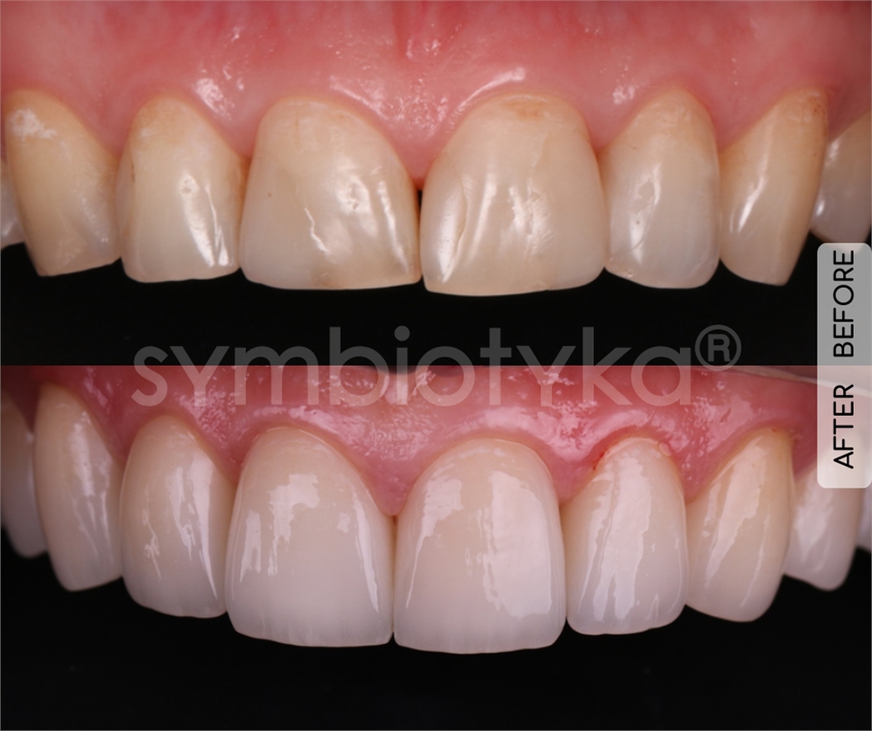 Crowns on the upper jaw