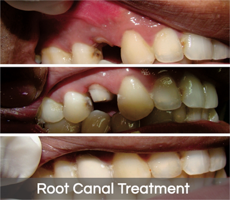 Root Canal Treatments