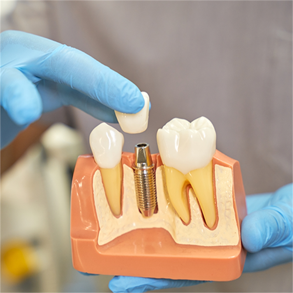 Dental Implant