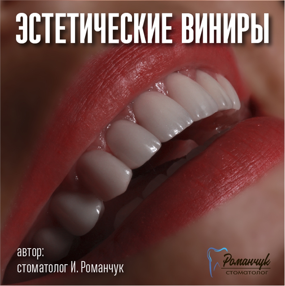 dental-veneers-8