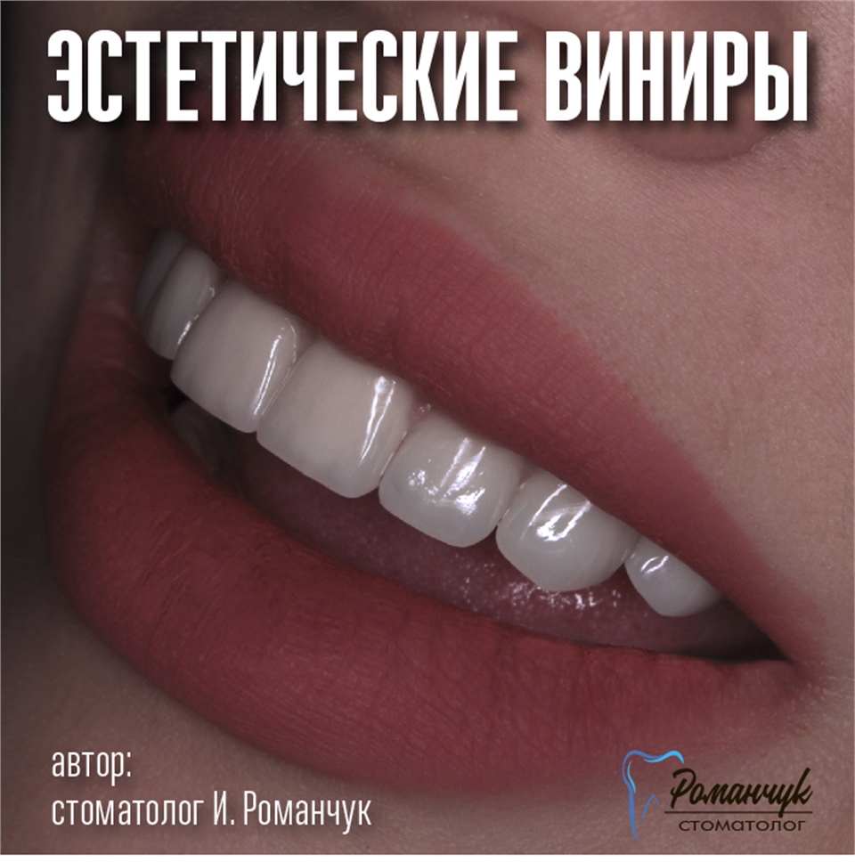 dental-veneers-10